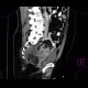 Sigmoid adenocarcinoma, peritoneal metastasis: CT - Computed tomography